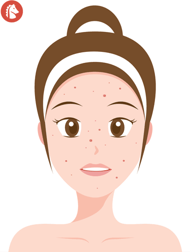 woman using accutane and curing her acne problems